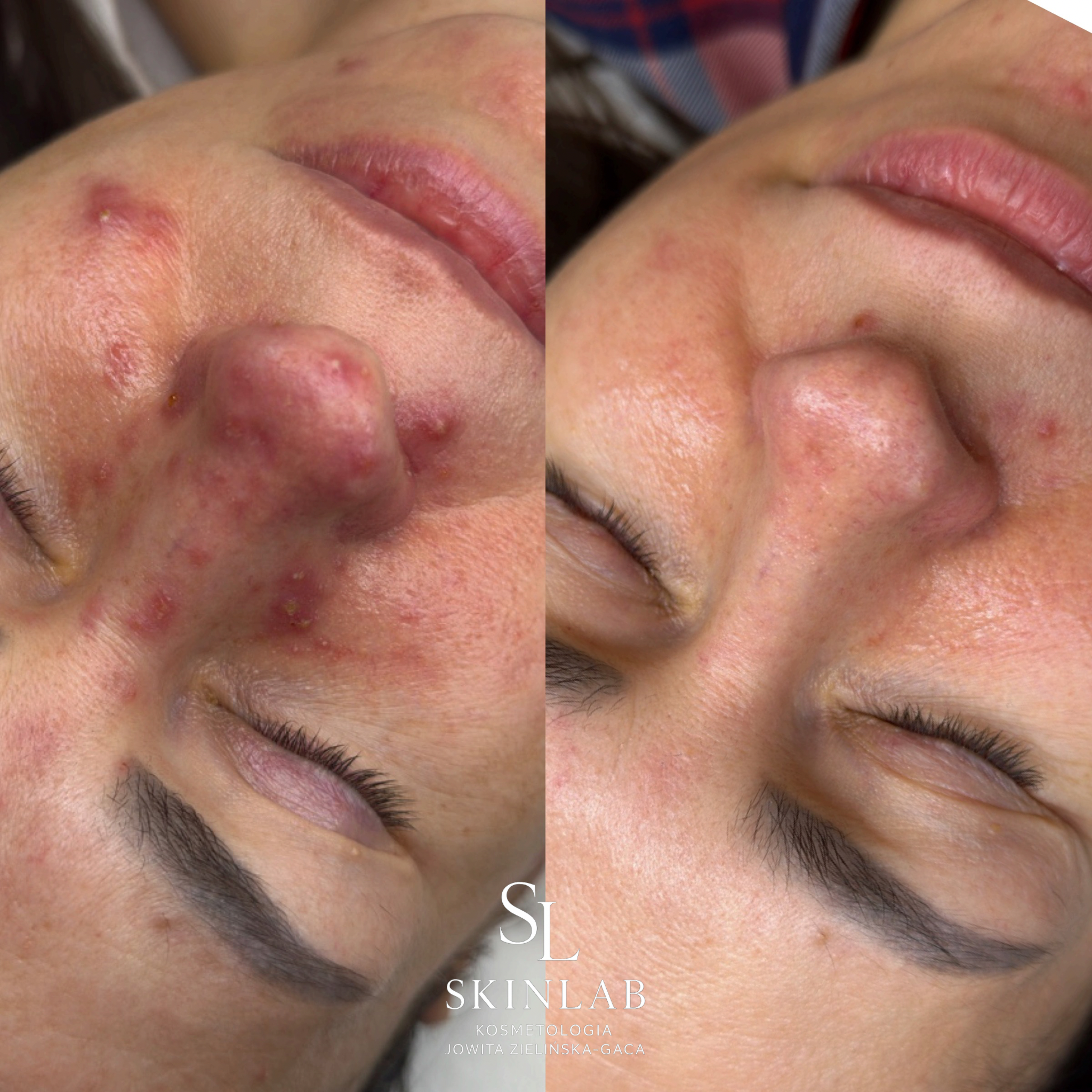 Efekt zabiegu kosmetologicznego - SkinLab Bydgoszcz